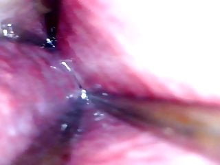 Gaped, Inserted, Endoscope, Gaping Hole