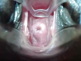 Shallow cervix penetration