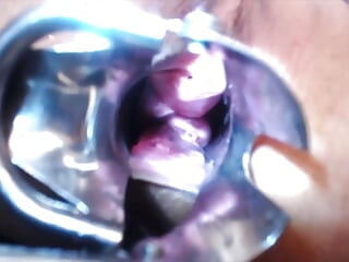 Speculum Cervix & Anal Exam Great View Inside