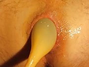 Analdehnung mit aufblasbaren Plug